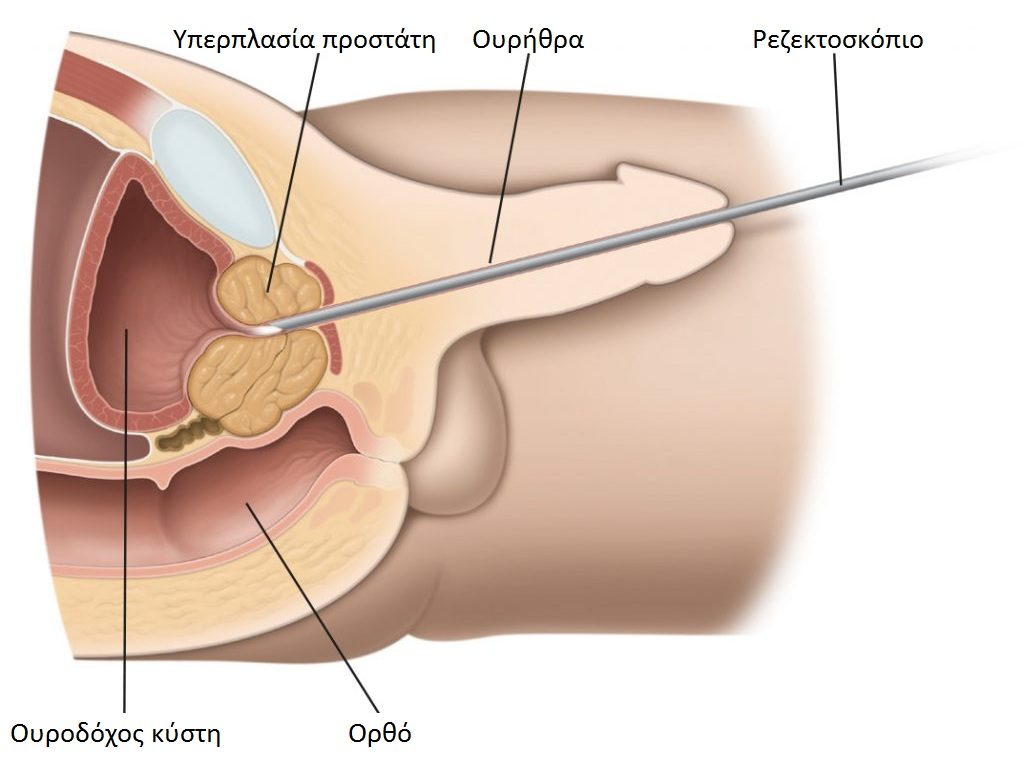 A prostatitis kezelése örökre a krónikus prosztatagyulladás gyógyíthatatlan