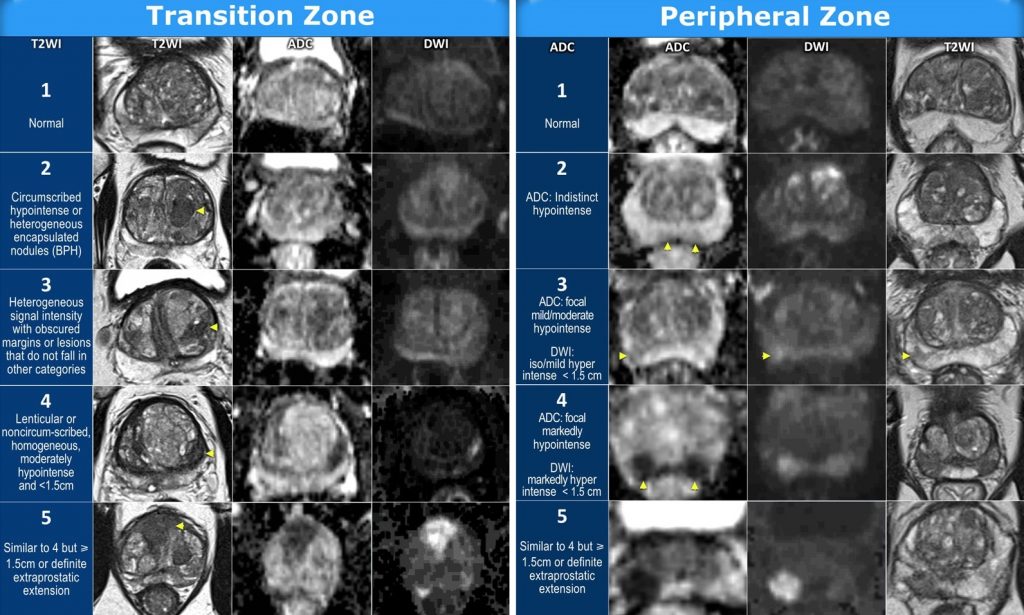 Πολυπαραμετρική Μαγνητική Τομογραφία Προστάτη (mpΜRI, multiparametric ...