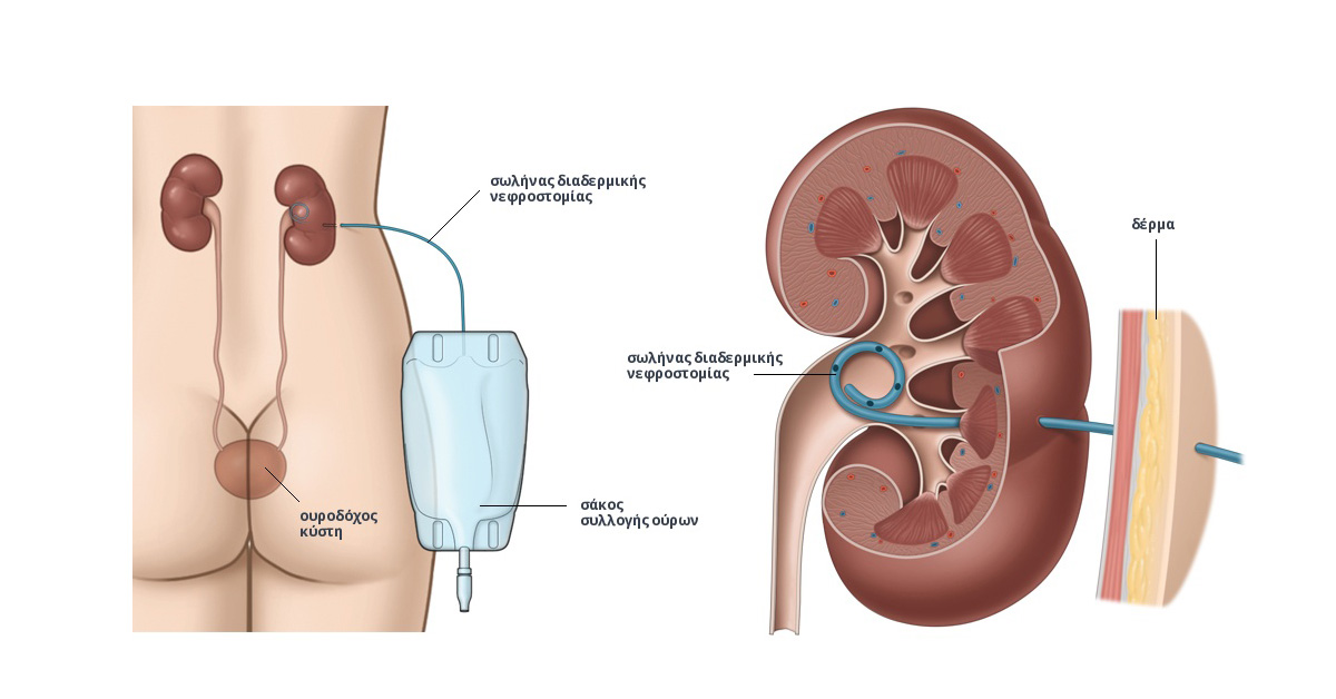 Операция мочевого канала. Нефростома – Стома почки. Дренажный катетер нефростома. Катетер стент мочеточника.