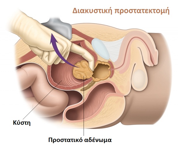 a prostatitis rezgés kezelése méret prosztatitis férfiakban