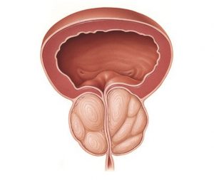 Prosztatagyulladás húgycsőmosás - Krónikus prostatitis ízületi fájdalom