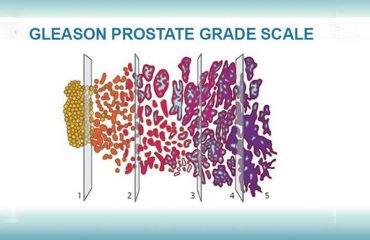 Gleason Prostate