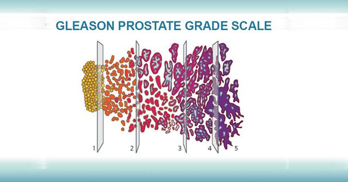 Gleason Prostate