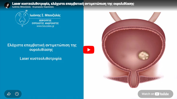 Διουρηθρική κυστεολιθοτριψία με laser υψηλής ισχύος