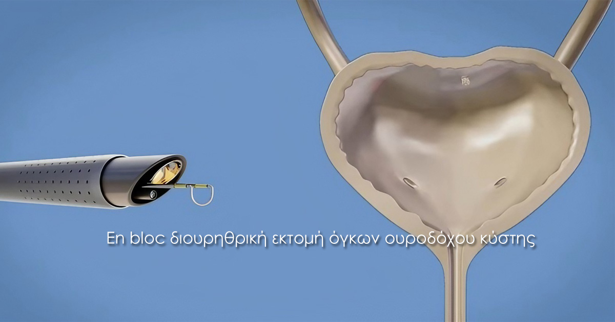 en bloc διουρηθρική εκτομή