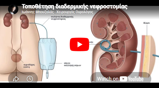 Video διαδερμικής Νεφροστομίας