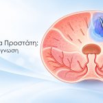 Fusion Βιοψία Προστάτη: Στοχευμένη Διάγνωση με Ακρίβεια