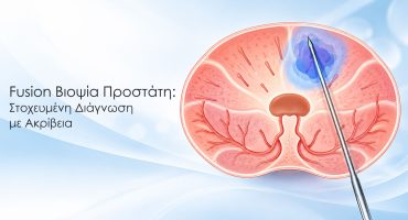 Fusion Βιοψία Προστάτη: Στοχευμένη Διάγνωση με Ακρίβεια